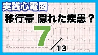 【心電図 読み方 ⑦】移行帯 Transition zone [upl. by Eshelman356]