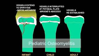 Imaging osteomyelitis acute and chronic [upl. by Liahus]