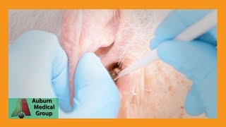 Chucks Tough Ear Wax Removal Part 1  Auburn Medical Group [upl. by Rennug]