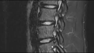 Ankle Fracture Series Management Technique for Lateral Malleolar Fractures  GAITS Academy [upl. by Aicilf]