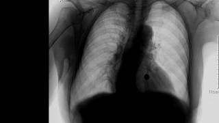 CASE 231 unilateral hypertranslucent left hemithorax X RAY [upl. by Faith]