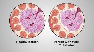 Beyond glucose A betacell centric approach to prevent type 2 diabetes [upl. by Forbes]