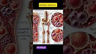 quotUnderstanding Multiple Myeloma Signs Risks and Treatment Optionsquot [upl. by Ahsilla572]