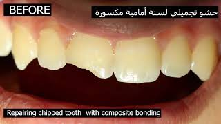 Chipped Front Tooth Repair  Dentist repair broken tooth with Composite Bonding [upl. by Rockwell976]