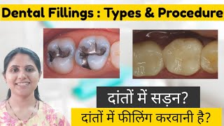 Dental Filling Types amp Procedure [upl. by Bresee]