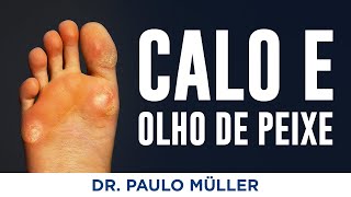 Calo e Olho de Peixe  Dr Paulo MÃ¼ller Dermatologista [upl. by Eaves]