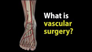 What is vascular surgery [upl. by Oicul722]