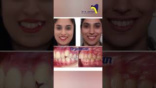 Miracle of Orthodontics Pre and Post orthodontic orthodontics orthodontist before after brace [upl. by Prudhoe]