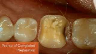 Immediate Dentin Sealing Technique [upl. by Arette]