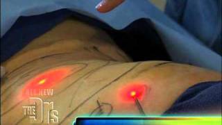 Elite MD featured on The Doctors tv show demonstrating LipoControl and Laser Liposuction part 1 [upl. by Aninaj152]