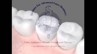 LANAP Laser Assisted New Attachment Procedure Laser Periodontal Treatment Laser Gum Treatment [upl. by Enwahs]