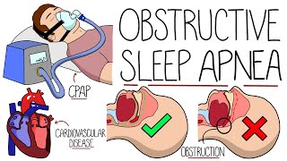 Understanding Obstructive Sleep Apnea Syndrome [upl. by Aihpled502]