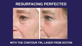 Mud and cucumbers VS Sciton Contour TRL Laser [upl. by Amoeji155]