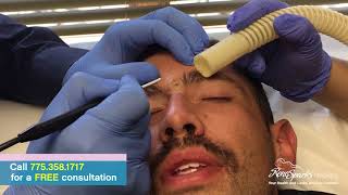 Facial Mole Removal of Brow Cheek and Scalp using Radiofrequency [upl. by Timi]