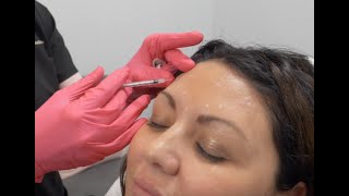 How Botox Really Works Botox Injections for a More Youthful Appearance [upl. by Alad]