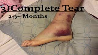 Sprained Ankle Ligaments Best Home Treatment [upl. by Notsag]