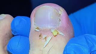 Removing Infected Ingrown Toenail [upl. by Leeda]