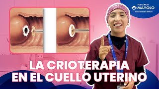 La crioterapia en el cuello uterino [upl. by Ehcrop]