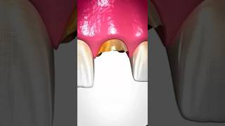 Bone Grafting Explained 🤔shorts bone subhanallaahforyou [upl. by Natloz]