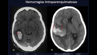 HEMORRAGIAS INTRACRANEALES [upl. by Caldera595]