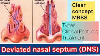 Deviated nasal septum DNS  types Clinical Features  treatment [upl. by Etteoj29]