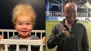 Uncombable Hair Syndrome and Other Rare Genetic Conditions [upl. by Ueih]