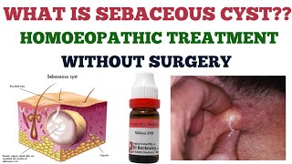 WHAT IS SEBACEOUS CYSTHOMOEOPATHIC TREATMENT drumarsaiyed sebaceouscyst homoeopathy [upl. by Mastat]