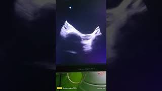 BOTH OVARY SCAN  ultrasound USG ovary [upl. by Aniluj]