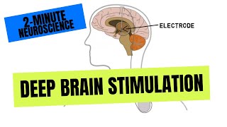 2Minute Neuroscience Deep Brain Stimulation [upl. by Enihpesoj]