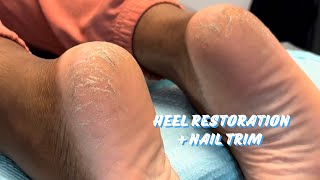 NO MORE CRACKED HEELS  MEDICAL PEDICURE [upl. by Debor]