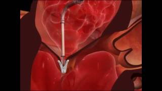 Mitral Valve Clip Repair ProcedureHow It Works [upl. by Atiluj]