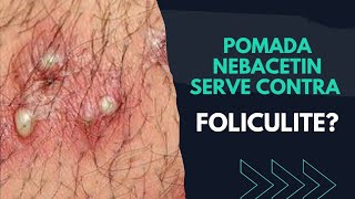 POMADA NEBACETIN SERVE CONTRA FOLICULITE  SAIBA [upl. by Etnovahs]