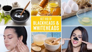 Easy Ways To Remove Blackheads And Whiteheads At Home [upl. by Amick]