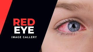 Red Eye Image Gallery [upl. by Maisel]