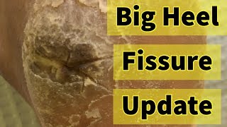 Big Heel Fissure Update The Heel Has Finally Healed [upl. by Norford]