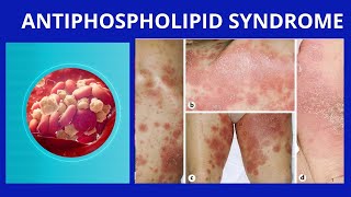 Antiphospholipid Syndrome [upl. by Jacquelin]