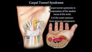 Carpal Tunnel Syndrome  Everything You Need To Know  Dr Nabil Ebraheim [upl. by Ichabod]