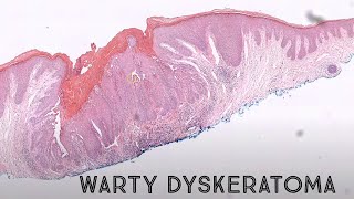 Warty Dyskeratoma acantholytic dyskeratosis pathology dermpath dermatology dermatopathology [upl. by Fedak692]