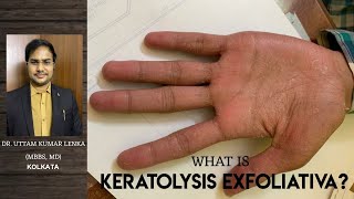 Keratolysis ExfoliativaRepeated peeling of skin from palm and sole Hath aur paw se Chamdi Nikalna [upl. by Ataga614]