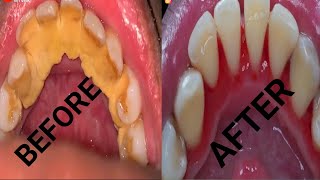 Teeth tartar remove [upl. by Abigail400]