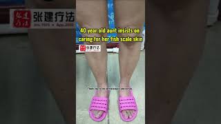 Can a 40 year old aunt maintain such good skin after treatment for ichthyosisichthyosis skincare [upl. by Nosirb]