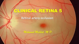 Clinical Retina 5  Retinal Artery Occlusion [upl. by Resay]