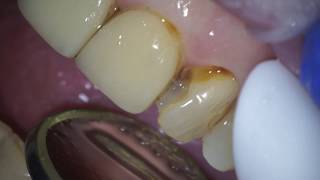 White front tooth filling [upl. by Olia]