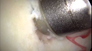 Articular Cartilage Paste Grafting Surgical Technique performed by Kevin R Stone MD [upl. by Kasevich620]