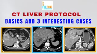 Liver CT  Protocol and Cases [upl. by Mel]