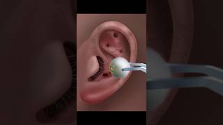 ASMR Ear Cleaning amp Treatment for Ultimate Relaxation asmr satisfying animation tretment [upl. by Malinda717]