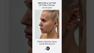 LIFTING Facial Before amp After 5 luni de la operație la Clinica Doctor Levy din București [upl. by Yrreb472]