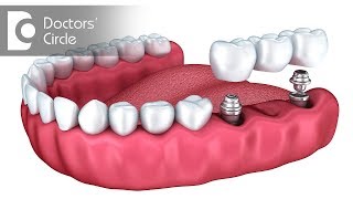 Can one replace multiple teeth using Dental Implants  Dr Mohammed Fayaz Pasha [upl. by Ardnaek600]