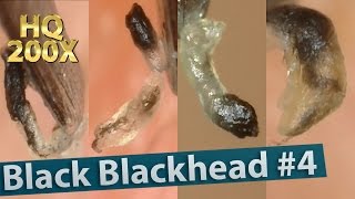 4 Black Blackhead  Squeezing Blackheads [upl. by Jayne]