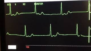 ECG Infarto Agudo al Miocardio en mujer de 77 años [upl. by Gable766]